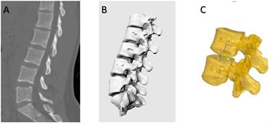 The 6 degrees-of-freedom range of motion of the L1–S1 vertebrae in young and middle-aged asymptomatic people